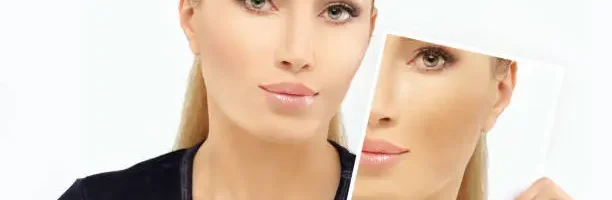 facial fat transfer